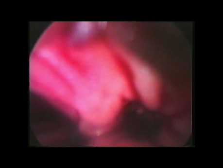 Laparoscopia. Salida. Perforación intestino delgado