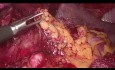 Gastrectomía laparoscópica D2: pasos clave del procedimiento