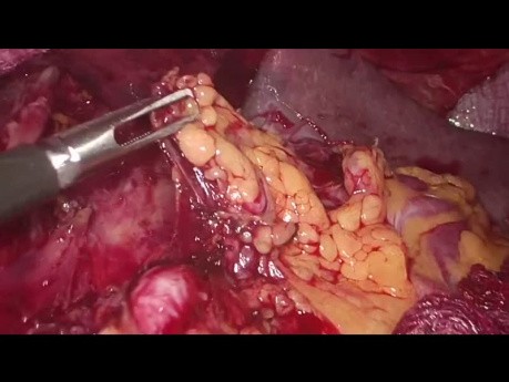 Gastrectomía laparoscópica D2: pasos clave del procedimiento