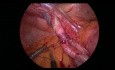 Manejo laparoscópico de una hernia interna estrangulada debajo de la arteria ilíaca externa con reconstrucción
