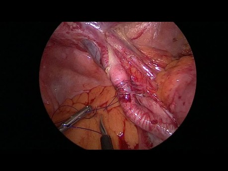 Manejo laparoscópico de una hernia interna estrangulada debajo de la arteria ilíaca externa con reconstrucción