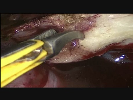 Histerectomía laparoscópica total en útero de 32 semanas de tamaño