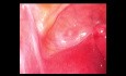 Cuerno uterino rudimentario gestacion año 1999