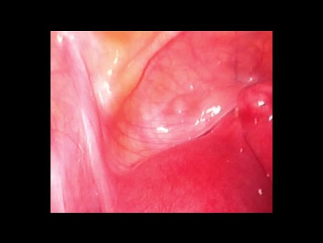 Cuerno uterino rudimentario gestacion año 1999