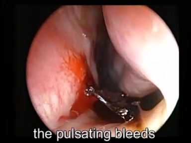 Hemorragia nasal - Cauterización con TCA al 50%