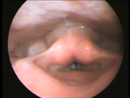 Pólipo de una cuerda vocal