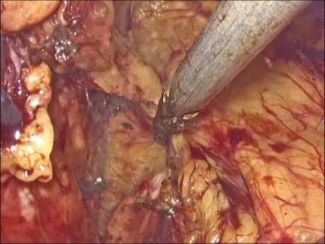 Laproscopia suprarrenal izquierda con adenoma, abordaje lateral derecho - transperitoneal