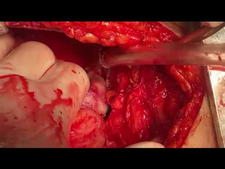 Paciente con Comisurotomía de Válvula Mitral Cerrada (CMVC) Anterior y Pseudoaneurisma Apical del Ventrículo Izquierdo (VI)