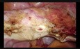 Histerectomía total laparoscópica 