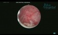 Miomectomía histeroscópica tipo 1 y 2