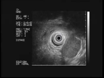 Vista endoscópica de Tumor del Estroma Gastrointestinal (GIST) 