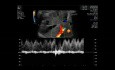 Evaluación del flujo del conducto venoso fetal