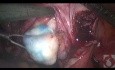 Localización de miomas durante una miomectomía laparoscópica