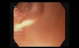 Ureteroileostomía