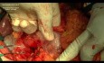 Gastrectomia total con linfadenectomía D2 con conservación del bazo