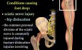 Lesión del nervio peroneo - video-clase