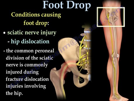 Lesión del nervio peroneo - video-clase