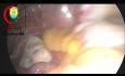 Vuelta diagnóstica en el dolor abdominal crónico recurrente