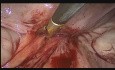 Remoción de la malla de polipropileno por vía laparoscópica 