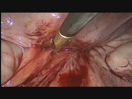 Remoción de la malla de polipropileno por vía laparoscópica 