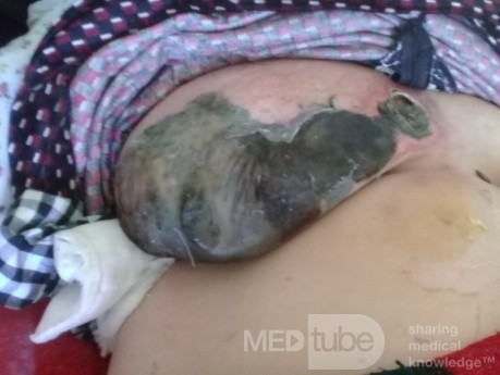 Gangrena infecciosa de una mama femenina