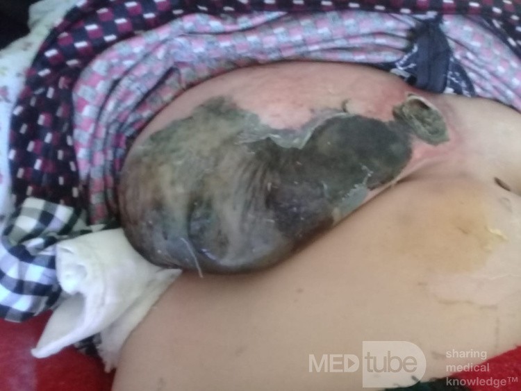 Gangrena infecciosa de una mama femenina