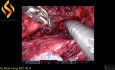 Disección robótica del nervio craneal izquierdo