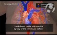 Tetralogía de Fallot - cardiopatía congénita