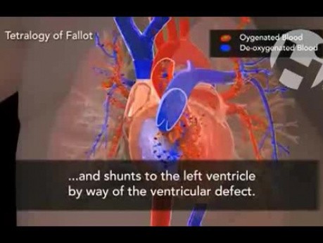 Tetralogía de Fallot - cardiopatía congénita