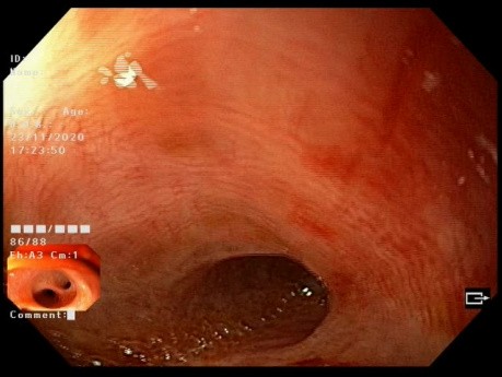 Uso de endoscopia superior para verificar el sistema biliar