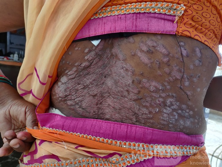 Dermatitis atópica