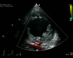 Ventricular izquierdo sin compactación