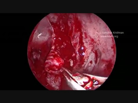 Meningoencefalocele