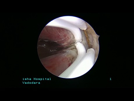 Resección histeroscópica del tabique intrauterino completo hasta el orificio interno