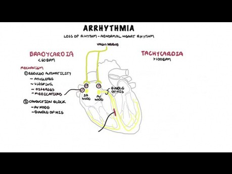 Descripción general de la arritmia - mecanismo de bradiarritmia y taquiarritmia