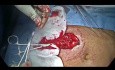 Reversión laparoscópica del procedimiento de Hartmann