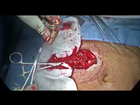 Reversión laparoscópica del procedimiento de Hartmann