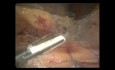 Resección anterior laparoscópica para el cáncer de colon rectosigmoide (video completo)
