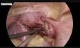 Miomectomía laparoscópica para el útero miomatoso de la pared posterior con endometriosis