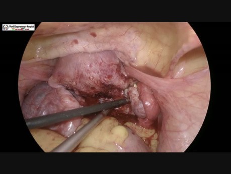 Miomectomía laparoscópica para el útero miomatoso de la pared posterior con endometriosis