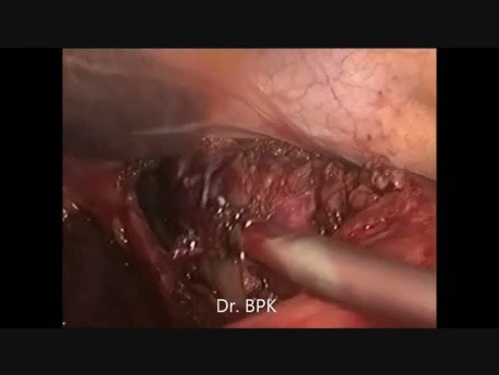 Esofagectomía toraco-laparoscópica