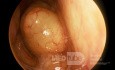 Pólipo coanal septal izquierdo que ocluye la coana derecha