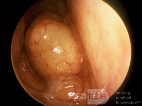 Pólipo coanal septal izquierdo que ocluye la coana derecha