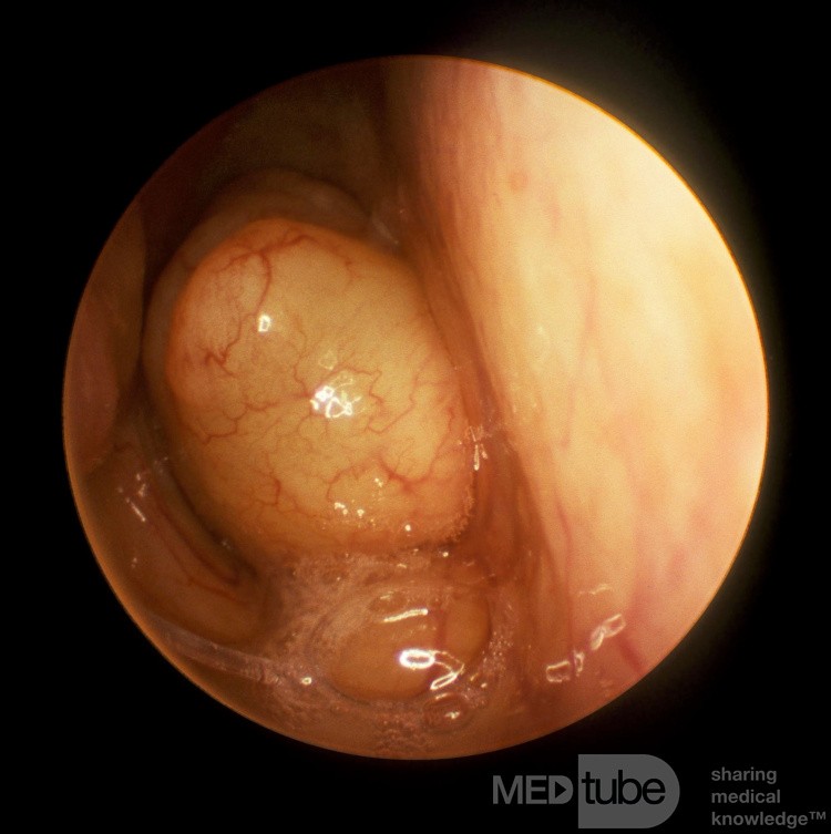 Pólipo coanal septal izquierdo que ocluye la coana derecha
