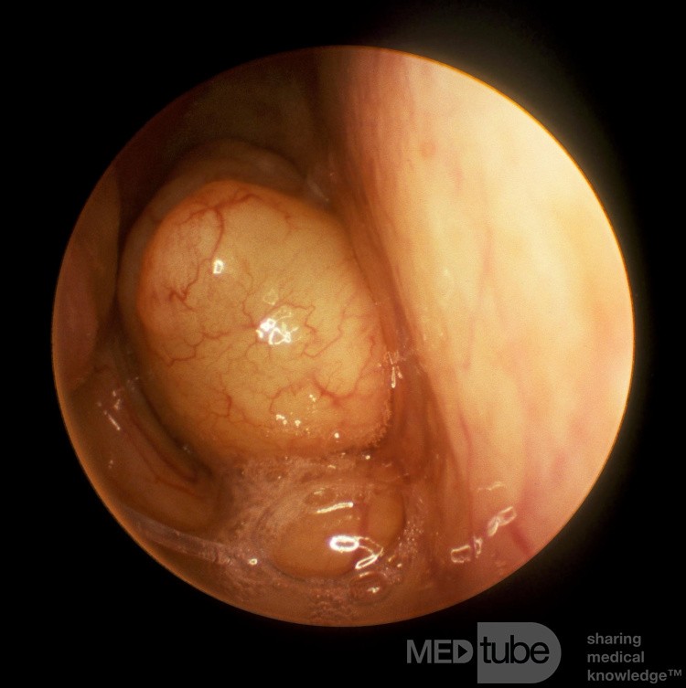 Pólipo coanal septal izquierdo que ocluye la coana derecha