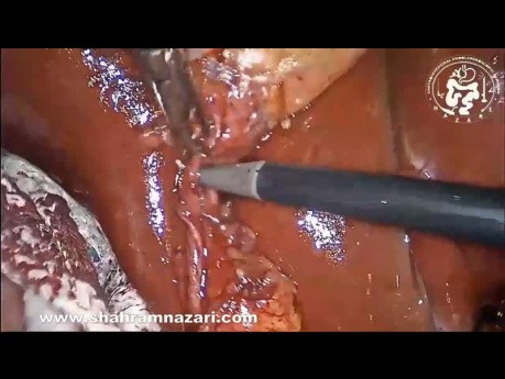 Tratamiento de las lesiones de los vasos sanguíneos de la pared abdominal anterior causadas por trócares laparoscópicos
