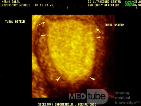 Endometrio en fase secretora (imagen 3D)