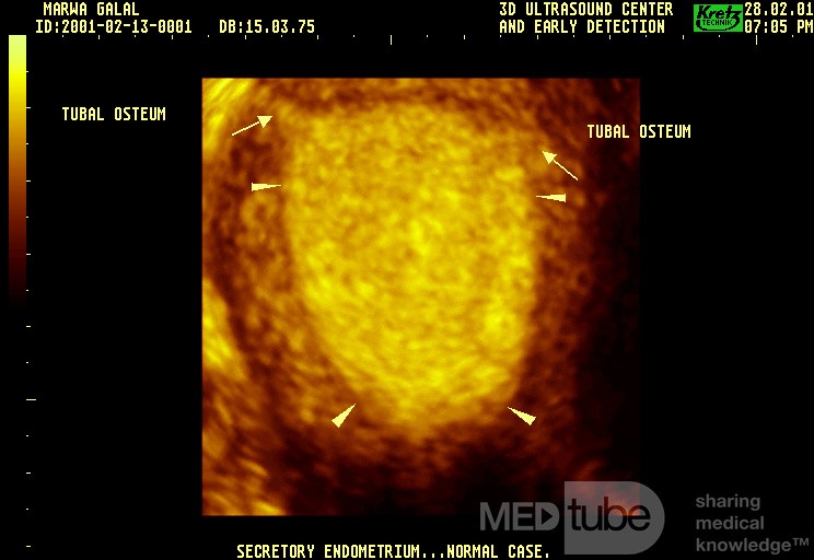 Endometrio en fase secretora (imagen 3D)