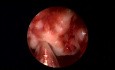 Resección de un tumor nasal similar a un teratoma - Cirugía de los senos nasales