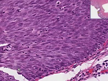 Metaplasia epitelial, cáncer - histopatología - cuello uterino